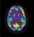 Frontal Lobes